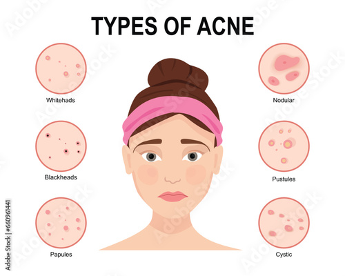 Types of acne. Skin problems