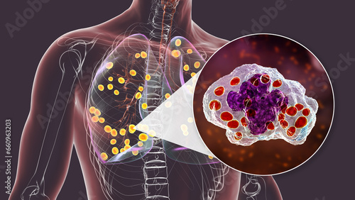 Lung histoplasmosis, a fungal infection caused by Histoplasma capsulatum, 3D illustration photo