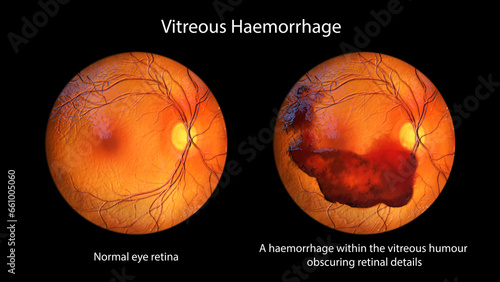 Vitreous hemorrhage as observed during ophthalmoscopy, 3D illustration photo