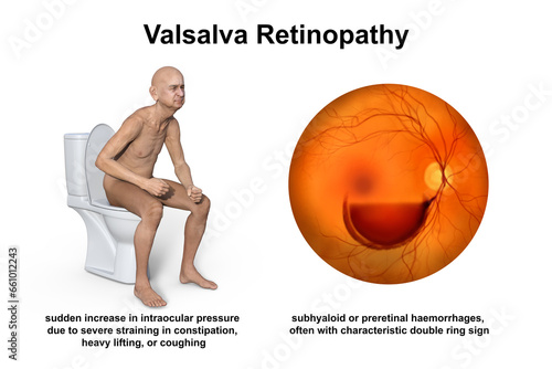 Valsava retinopathy, a preretinal hemorrhage caused by a sudden increase in intraocular pressure due to severe straining in constipation, 3D illustration photo