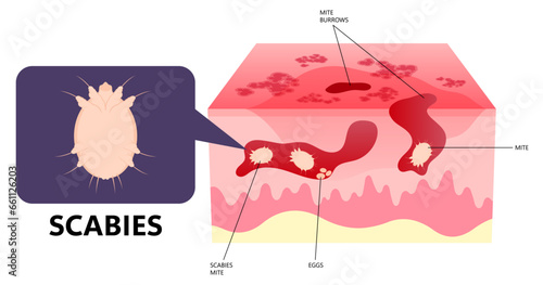 Eczema or dermatitis of skin red and itching