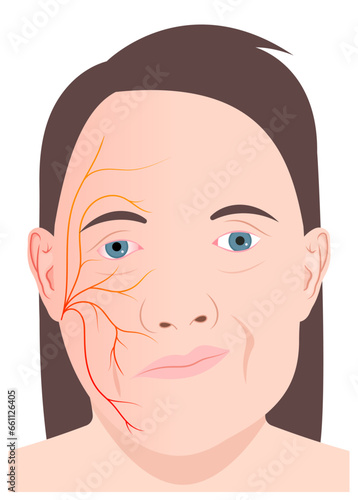Face nerve injury central motor neuron infectious or ptosis of bell's cranial hyperacusis in the hemiplegia nystagmus and chicken pox skin simplex otalgia tinnitus multiple sclerosis photo