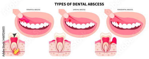 Cracked and broken wisdom teeth Cavities the swollen pain of oral cavity in bad breath hygiene health
