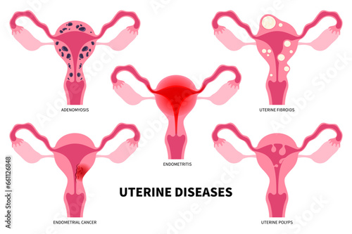 Uterine diseases with endometriosis heavy menstruation periods painful exam infertility anatomy photo