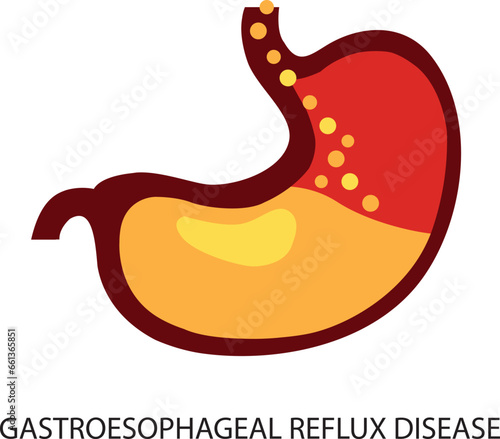 Gastroesophageal reflux disease. Stomach GERD heartburn esophagus medical illustration.