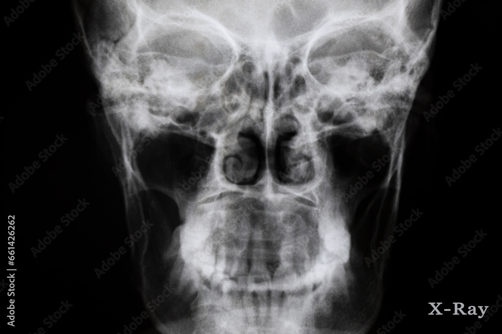 x ray image of skull x ray image of skull