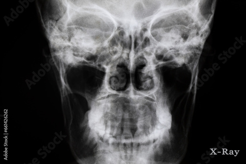 x ray image of skull