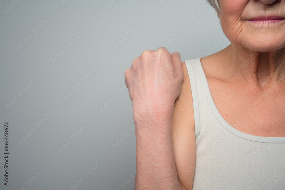 Woman with atopic eczema, close-up on arm, skin problem Woman with atopic eczema, close-up on arm, skin problem