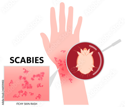 Hand and wrist the dermis skin inflammation with red itching caused by scabies in medical