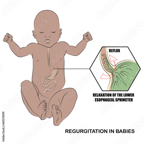Regurgitation in babies, stomach contents that flow easily from the stomach into the mouth easily, accompanied by belching.