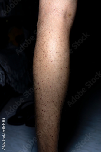 Vasculitis. Vasculitis in legs. Small red or purple spots. Post covid syndrome due to an immunological reaction of the body. Grain. Inflammation of the blood vessels. Rare disease. Photography. © Fernando Astasio