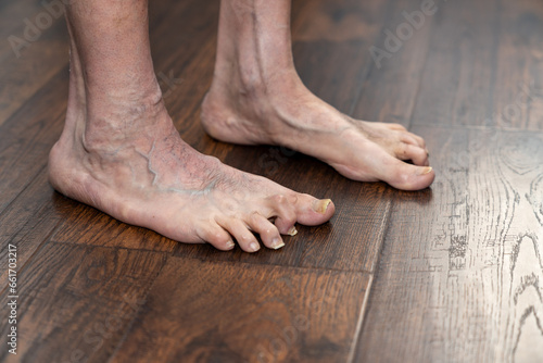 Foto Man's deformed hammertoes showing left foot one year after surgery showing multiple conditions including toenail fungus and phlebitis