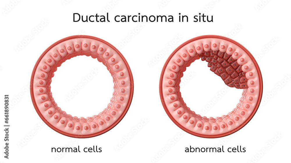 breast cancer, Ductal carcinoma in situ with comparison normal cells ...