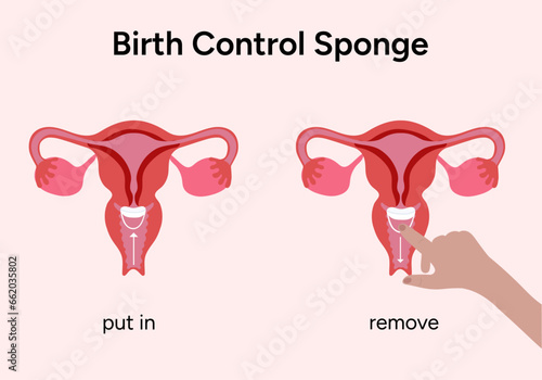 Birth control sponge illustration correct incorrect 