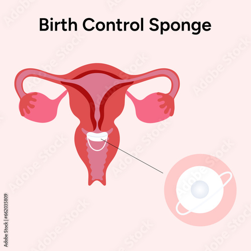 Birth control sponge illustration with vagina illustration 