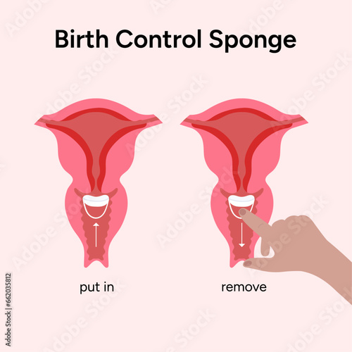 Birth control sponge illustration instruction 