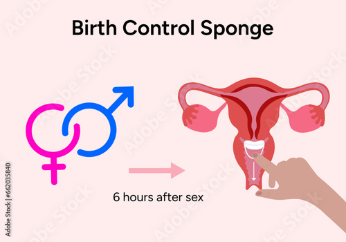 Birth control sponge medicine illustration