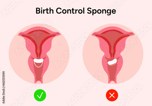 Birth control sponge illustration correct incorrect 