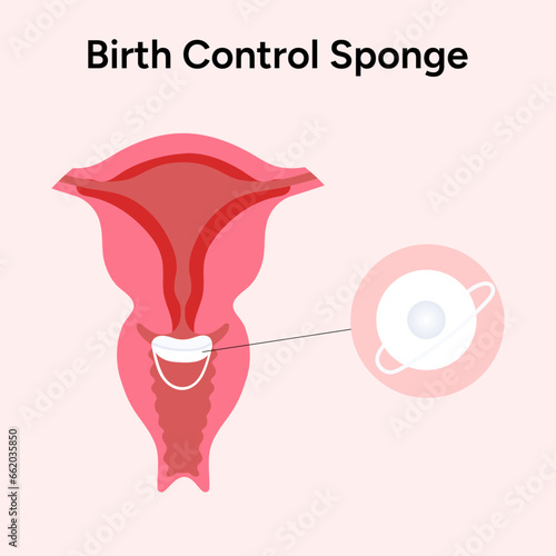 Birth control sponge infographic 