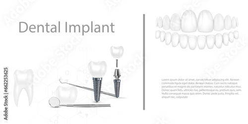 Dental implant structure medical pictorial educative infographic poster with molar replacement end healthy tools models vector illustration.