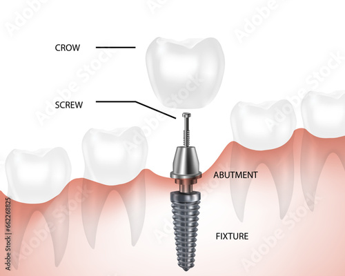 Dental implant component parts, tooth denture components, vector.