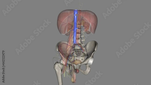 The inferior vena cava (IVC) is a large retroperitoneal vessel formed by the confluence of the right and left common iliac veins . photo