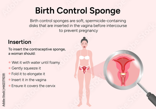 Birth control sponge gynecology illustration insertion