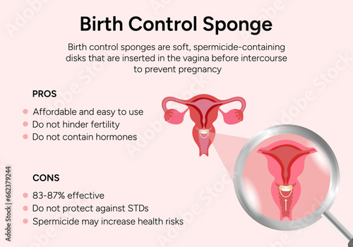 Birth control sponge illustration pros and cons