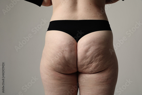 Obese female buttocks with cellulite and stretch marks. Horizontal mock-up. photo