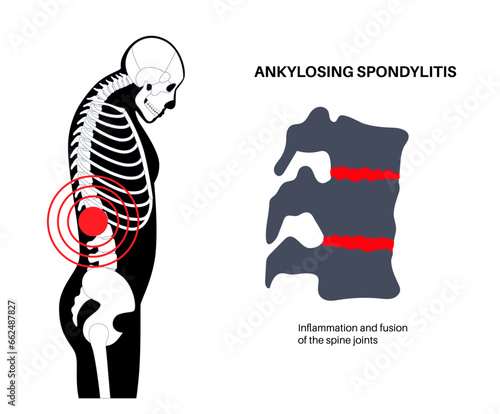 Obraz na płótnie Ankylosing spondylitis disease