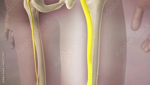 Sciatic Nerve Pain 3D Animation