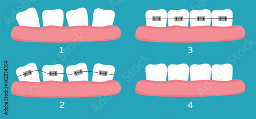 Crooked teeth alignment with dental braces treatment stages