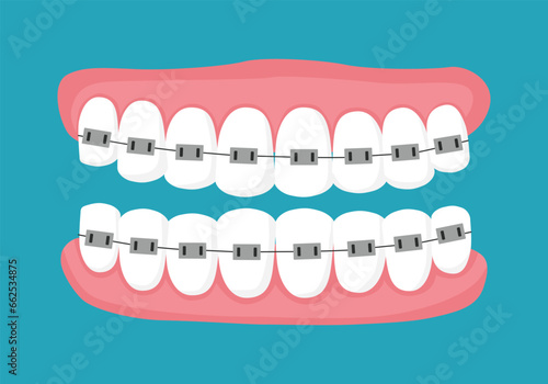 Alignment of teeth with braces