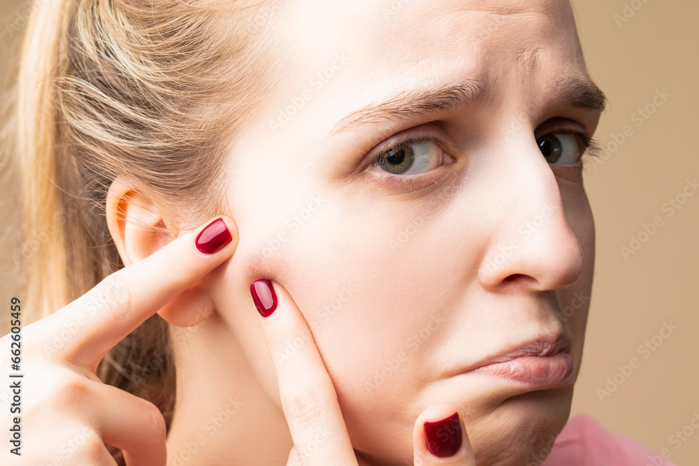 Skin Care Ideas. Young Emotional Caucasian Blond Woman With Skin Problems Squeezing Pustules By Fingers On Beige. Skin Care Ideas. Young Emotional Caucasian Blond Woman With Skin Problems Squeezing Pustules By Fingers On Beige.