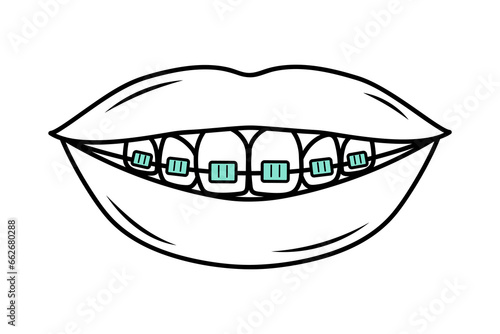 Human mouth with teeth in braces in doodle style. Corrective Orthodontics. Dental care. Linear vector illustration.