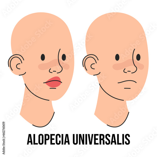 Alopecia universalis vector isolated. Male and female character suffering from hair loss. Completely bald head, no brows, eyelashes, beard or moustache. Medical condition. Baldness, body disease.