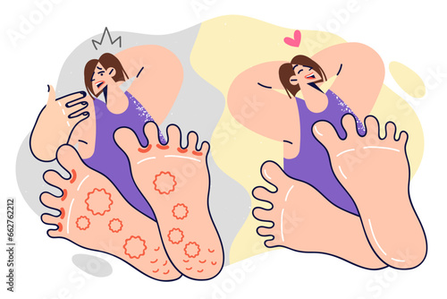 Woman with foot fungus before and after using medicinal ointment or seeing doctor