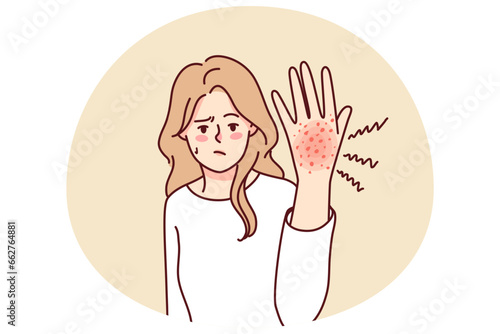Unhappy woman suffer from redness on hand. Unwell girl struggle with psoriasis or seasonal allergy. Healthcare concept. Vector illustration.