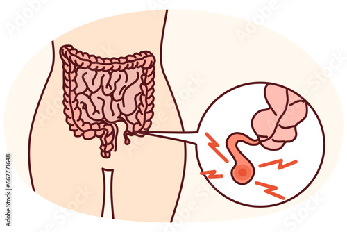 Closeup of human body with inflamed appendix. Person suffer from appendicitis need surgery. Vector illustration.