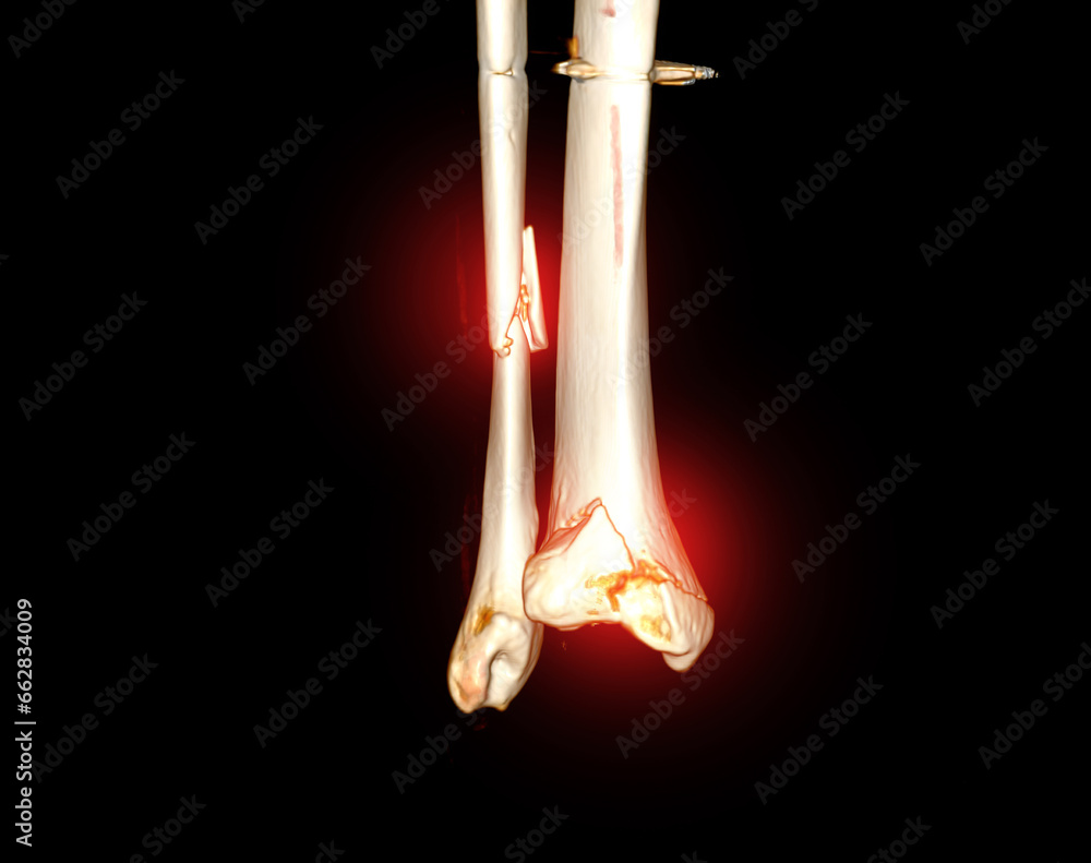 CT Scan ankle joint 3D Rendering image showing fracture tibia and ...