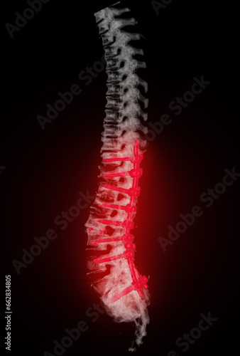  CT scan of thoracic and lumbar spine 3d rendering showing pedicle screw implant after surgical decompression and spinal fusion.