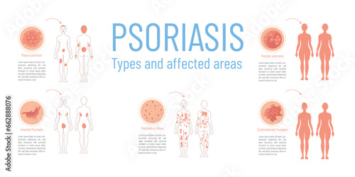 Infographic with graphic representation of the different types of psoriasis and the areas on the body that are affected.