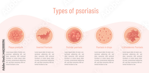 Infographic on the type of psoriasis and what it looks like. photo