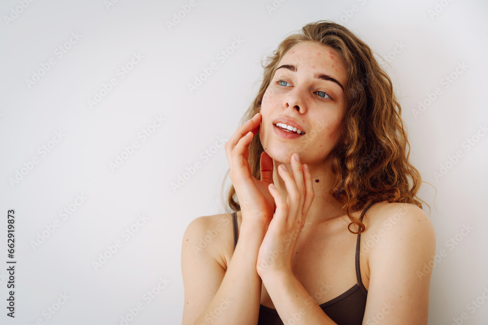 Close-up of a smiling woman with acne and rashes on her face. Medicine and cosmetology. Copy space. Close-up of a smiling woman with acne and rashes on her face. Medicine and cosmetology. Copy space.