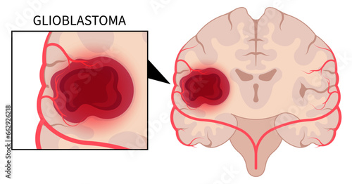 Brain tumor or malignant cancer with hemorrhage cell anatomy in medical