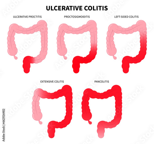 Types of Diarrhea or Ulcerative colitis and Crohn's disease with painful ulcer in bowel photo