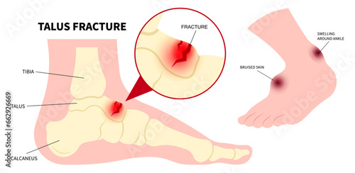 Foot injury with the Talus bone fracture and ankle painful range of motion in medical photo