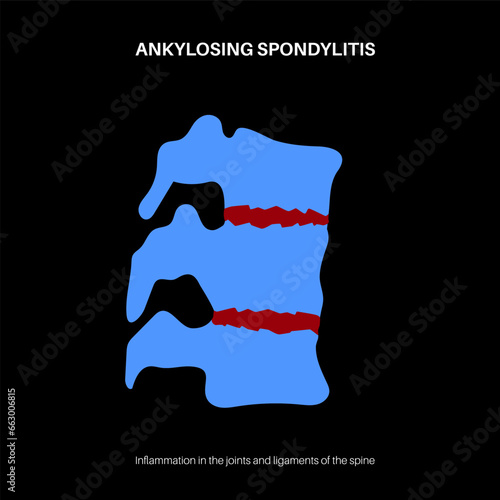 Ankylosing spondylitis disease