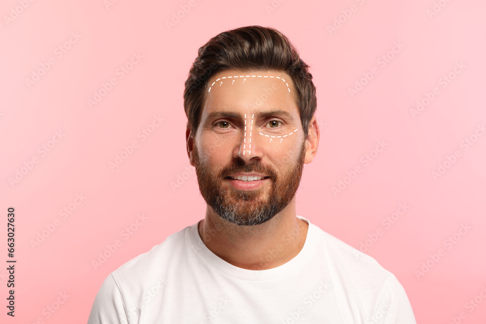 Man with markings for cosmetic surgery on his face against pink background - obrazy, fototapety, plakaty 