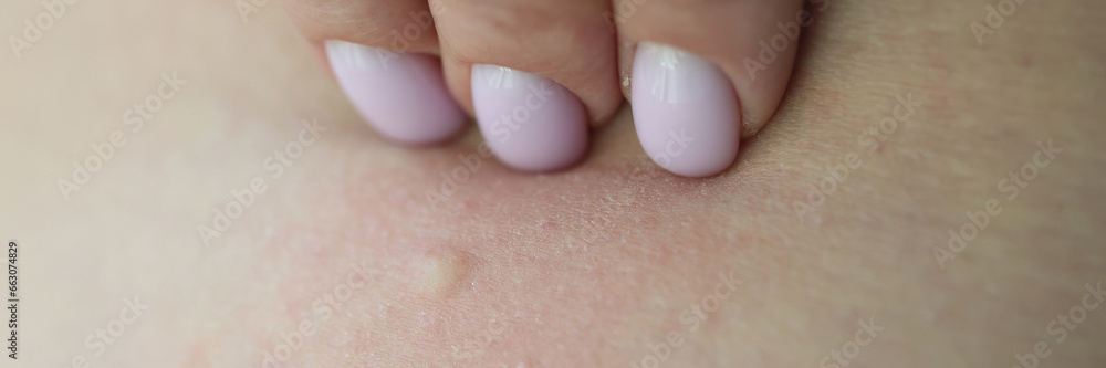 Hand of woman scratches small pimple after insect bite Hand of woman scratches small pimple after insect bite